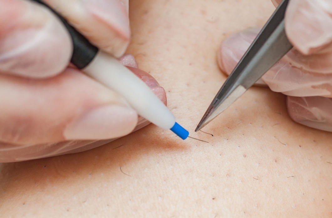 Luxury derm technique électrolyse