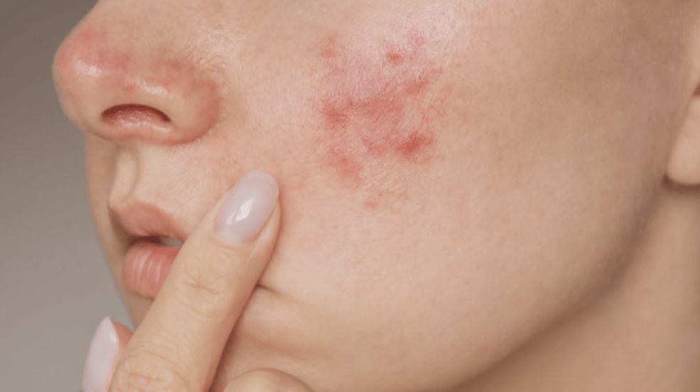 Luxuryderm : l'erreur à ne pas faire en été pour réduire votre peau grasse