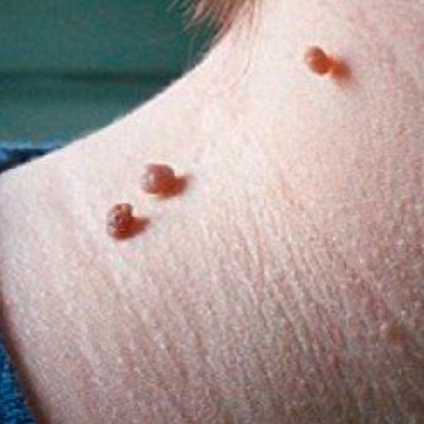 Luxuryderm traitement des acrochordons