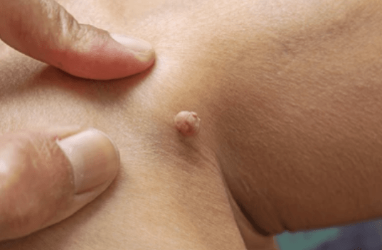 Luxuryderm traitement des acrochordons les enlever en toute sécurité