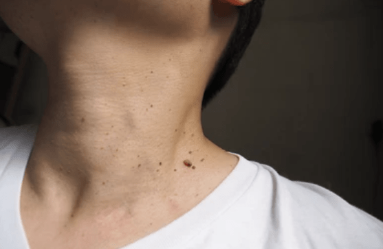 Luxuryderm traitement des acrochordons les enlever en toute sécurité