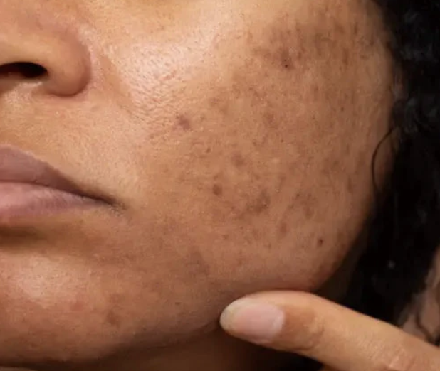 luxuryderm-traitement-peau-taches-brunes-hyperpigmentation-post-inflammatoire-cote-d-azur