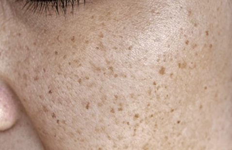 luxuryderm-traitement-peau-taches-brunes-lentigo-cote-d-azur